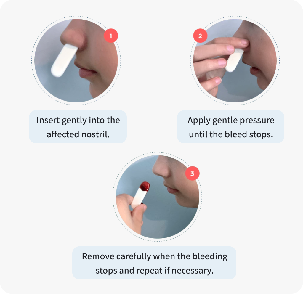 Nampons™ for Nosebleeds